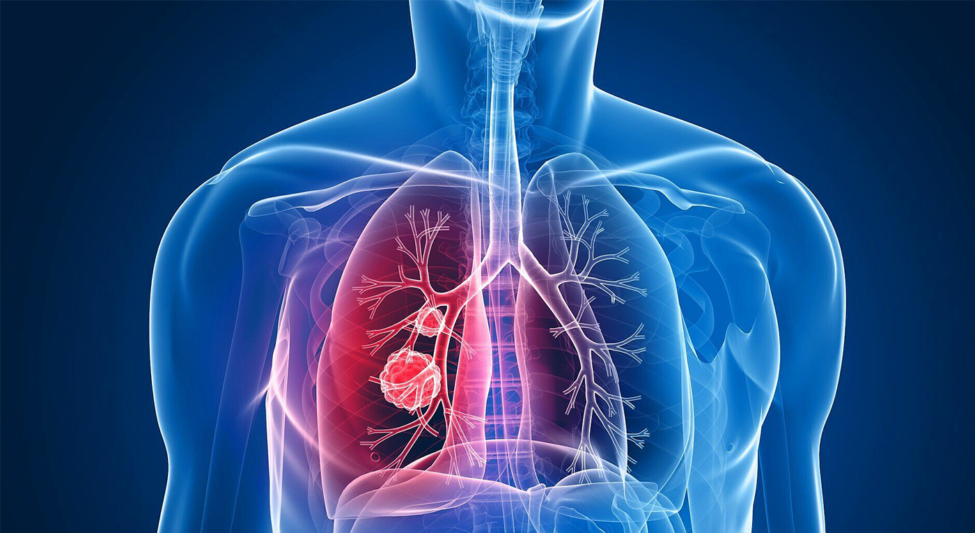 καρκίνος του πνεύμονα
